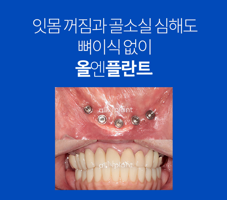 잇몸 꺼짐과 골소실 심해도 뼈이식 없이 올엔플란트