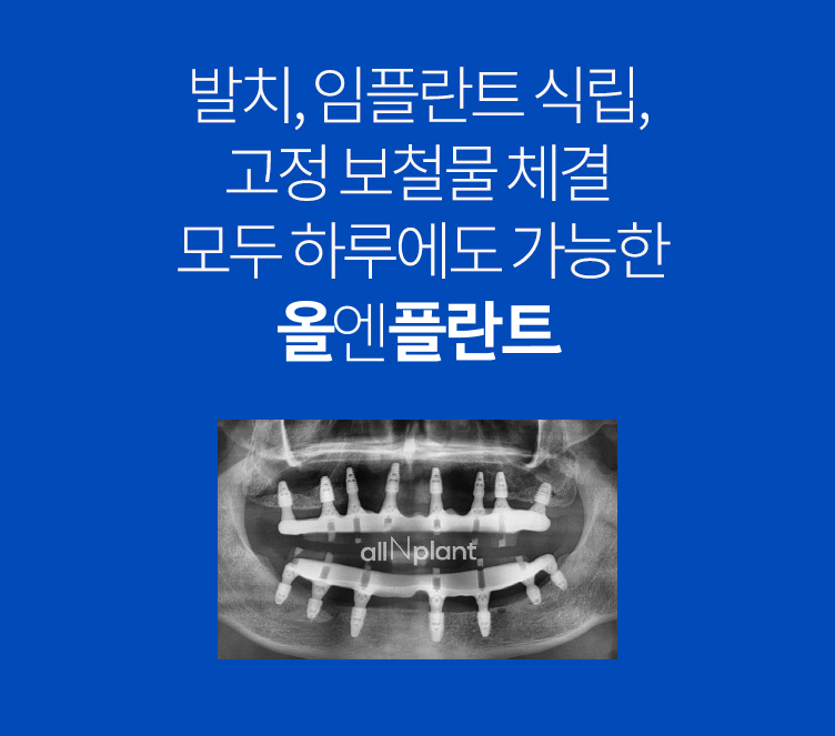 발치, 임플란트 식립, 고정 보철물 체결 모두 하루에도 가능한 올엔플란트