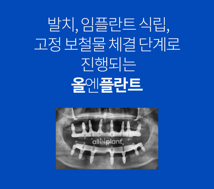 발치, 임플란트 식립, 고정 보철물 체결 단계로 진행되는 올엔플란트