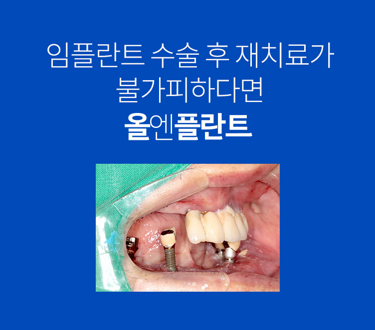 임플란트 수술 후 재치료가 불가피하다면 올엔플란트