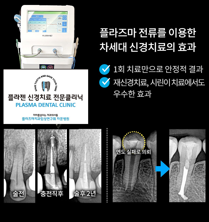 플라즈마 전류를 이용한 차세대 신경치료의 효과 - 1회 치료만으로 안정적 결과 / 재신경치료, 시린이 치료에서도 우수한 효과