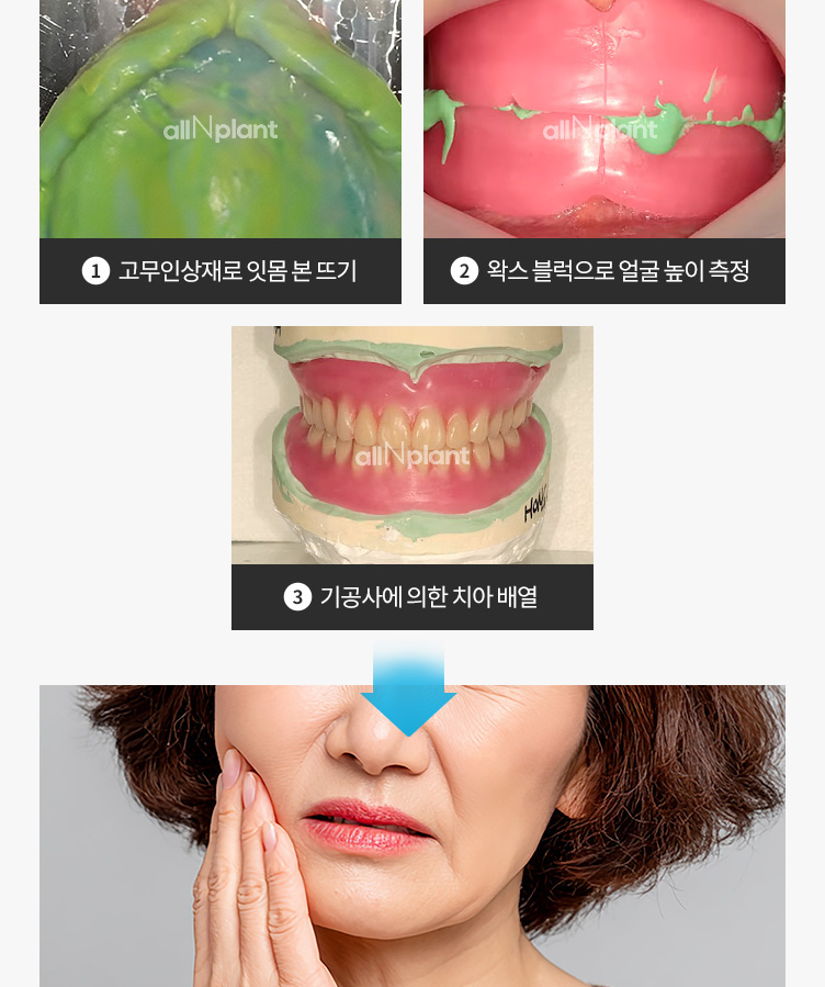 1. 고무인상재로 잇몸 본 뜨기 | 2. 왁스 블럭으로 얼굴 높이 측정 | 3. 기공사에 의한 치아 배열